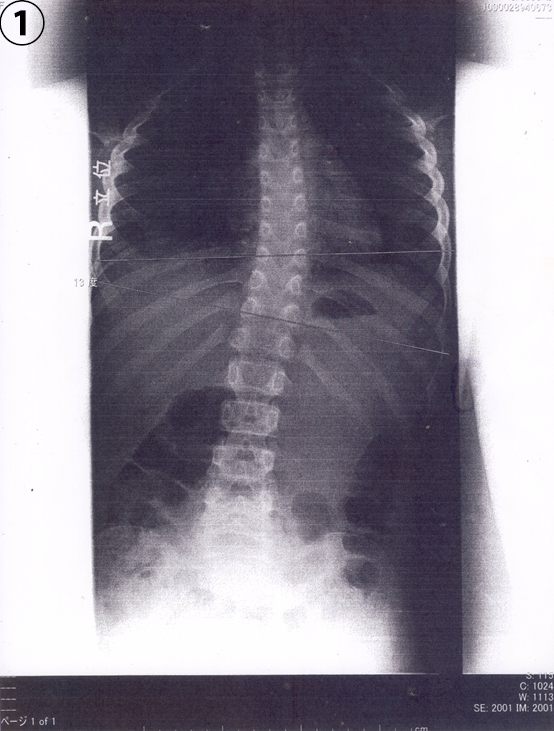 急性脳症後遺症の治療と脊柱側弯症が完治 治療前