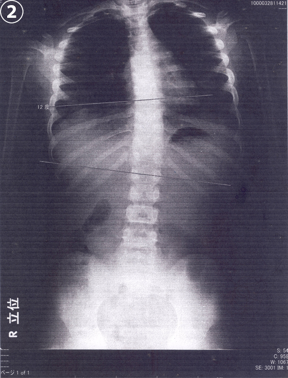 急性脳症後遺症の治療と脊柱側弯症が完治 治療中1