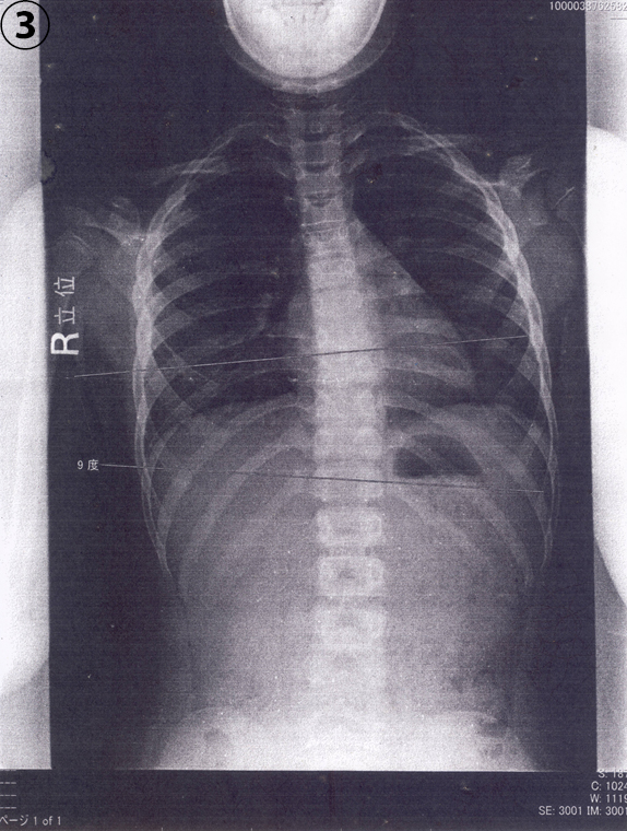 急性脳症後遺症の治療と脊柱側弯症が完治 治療中2