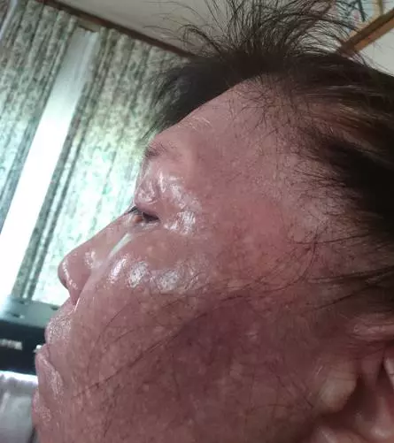 悪性リンパ腫治療前1