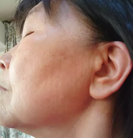 悪性リンパ腫治療後1