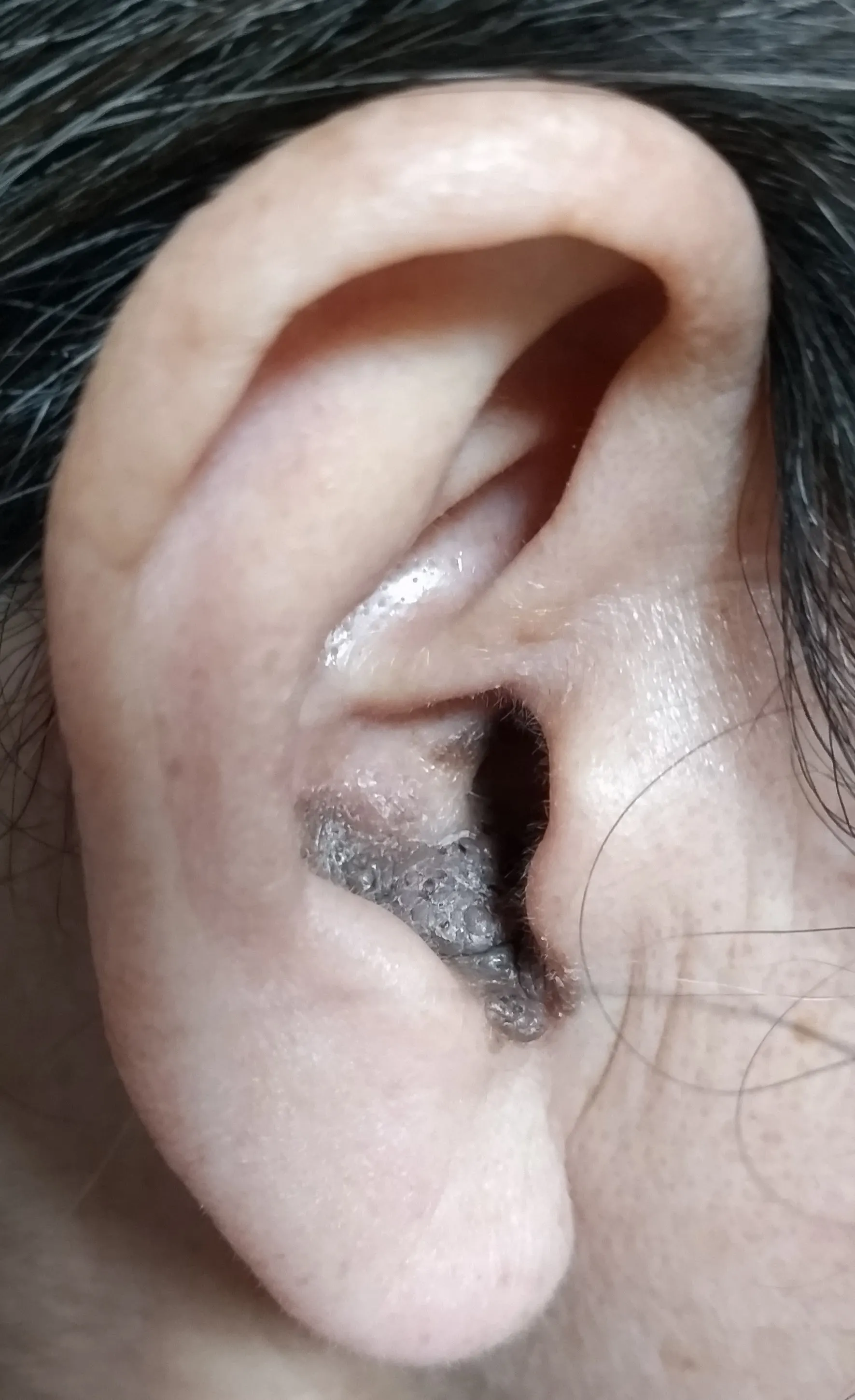 外耳腫瘍治療前