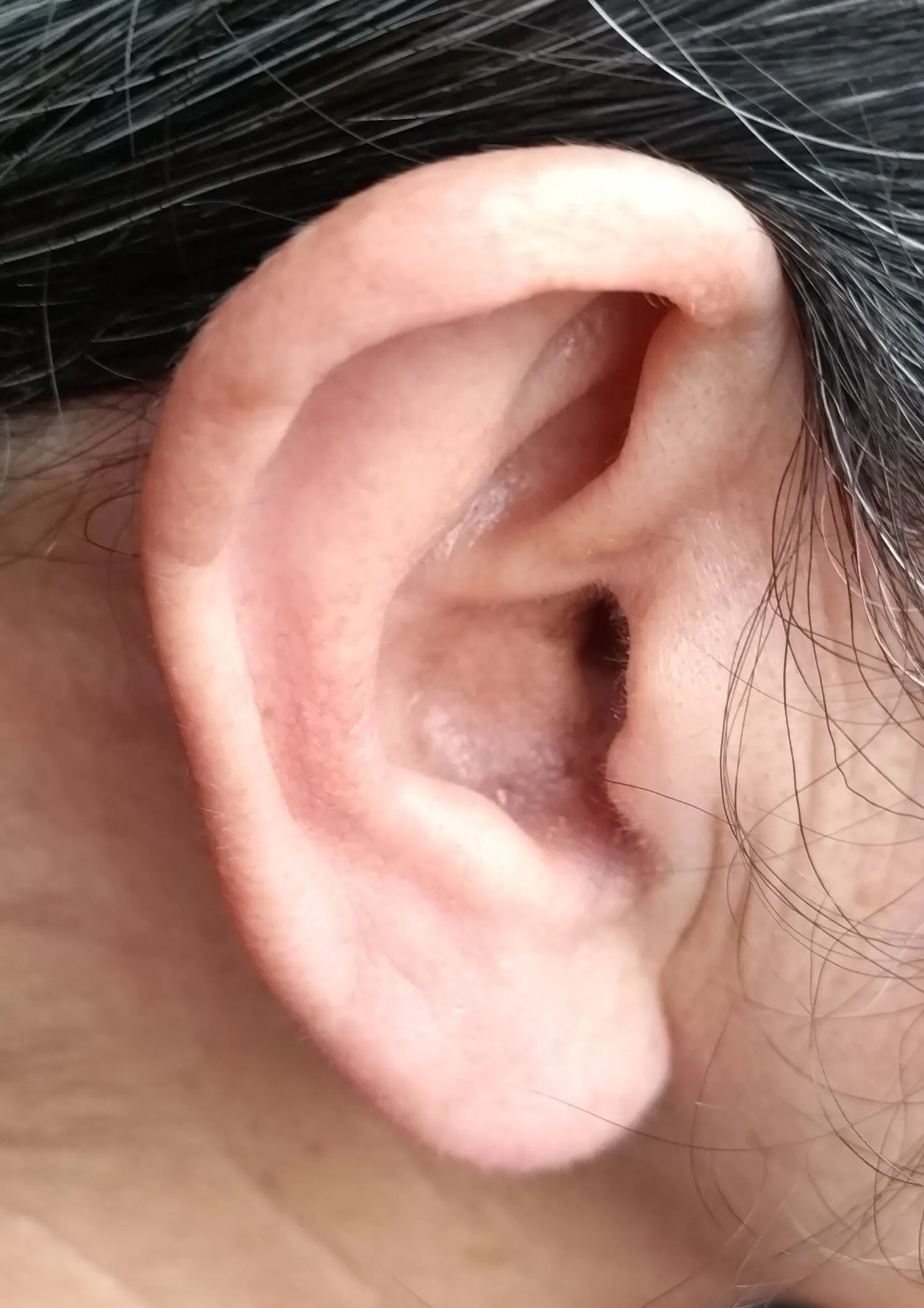 外耳腫瘍治療後