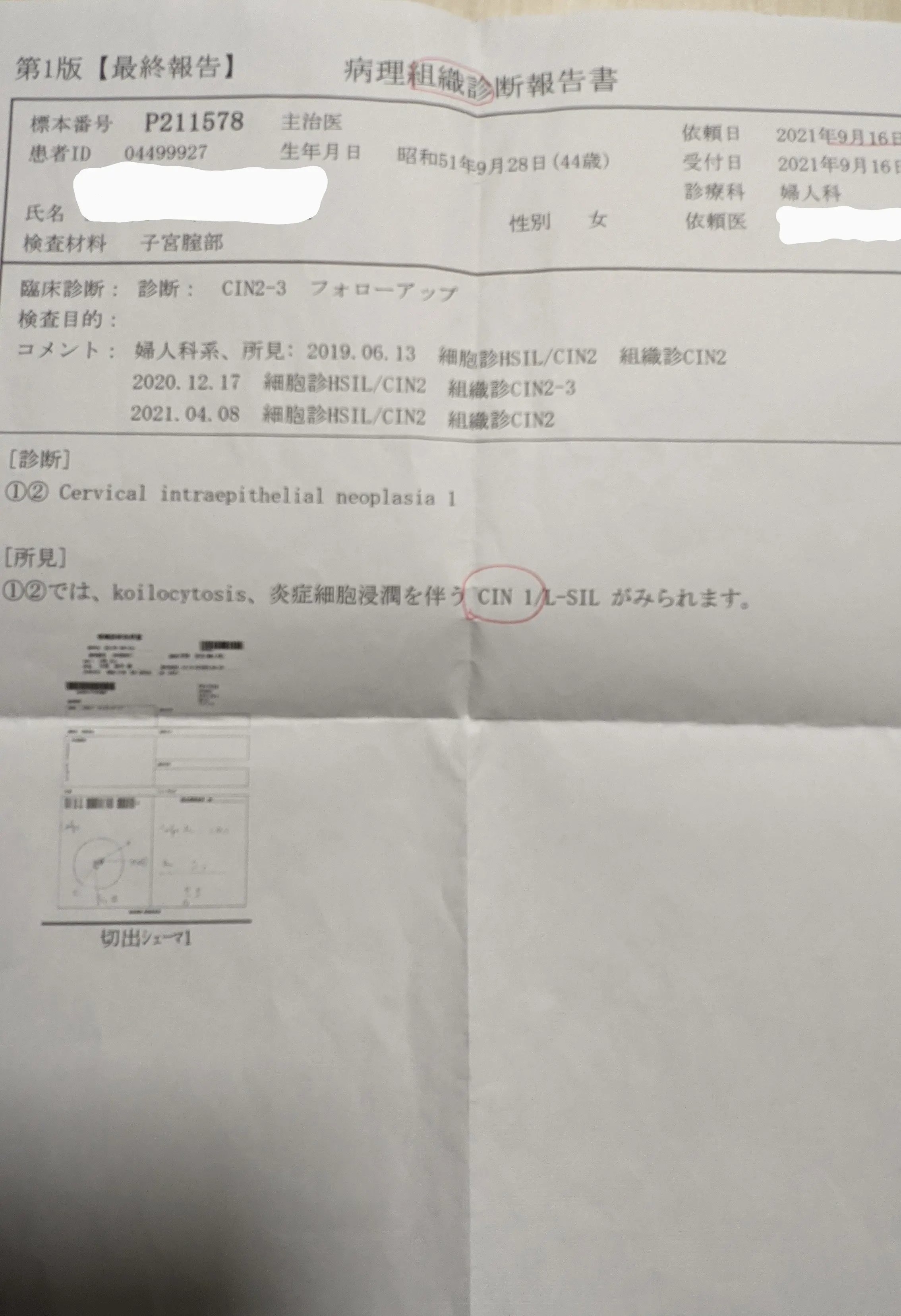 子宮頸がん子宮異形成の治療