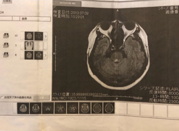 多発性硬化症のMRI画像