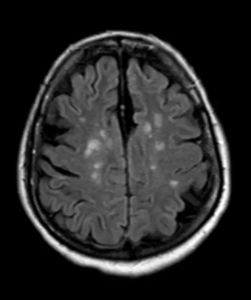 多発性硬化症のMRI画像治療前