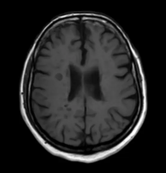多発性硬化症のMRI画像治療後